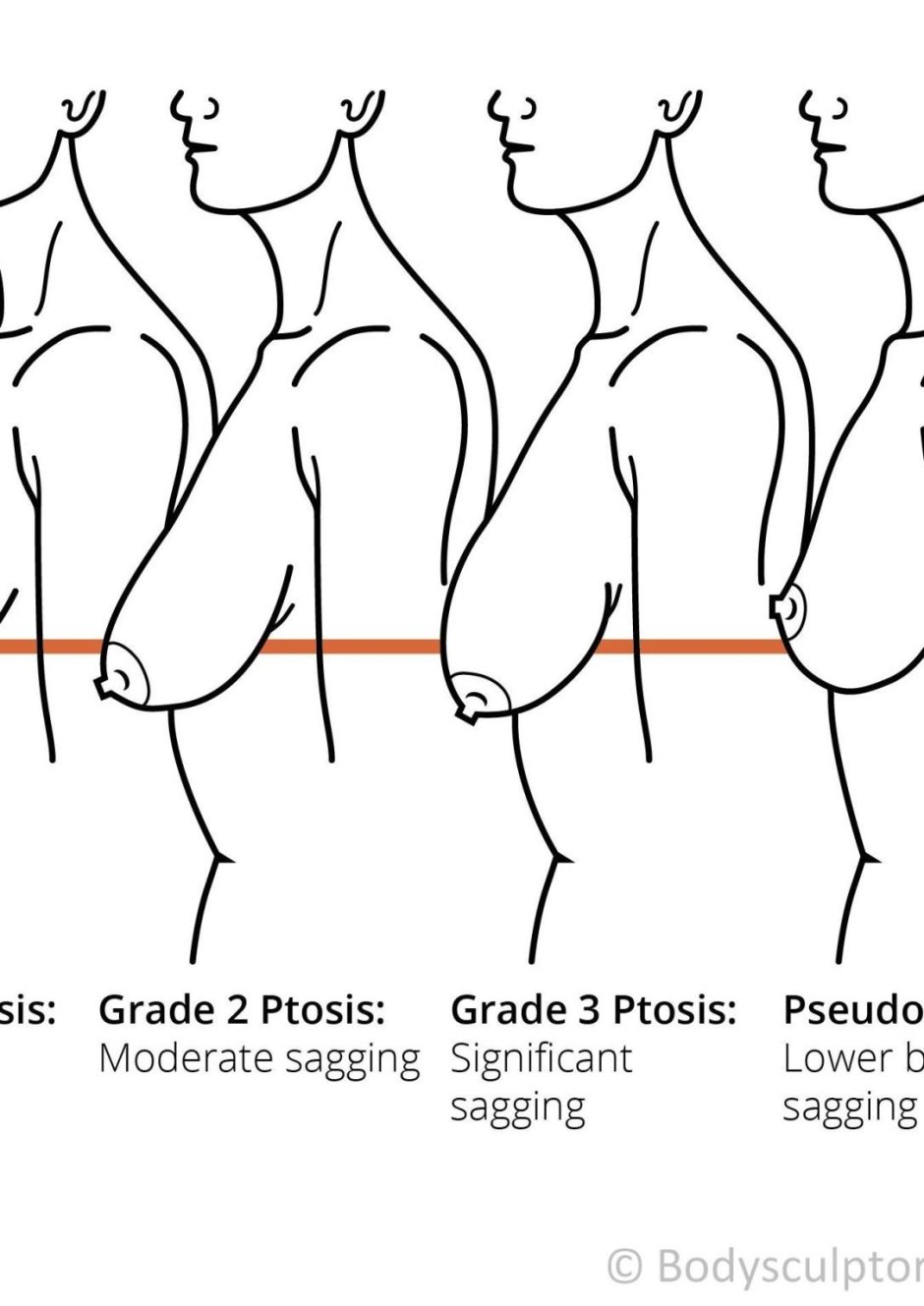 Птоз грудных желез 3 степени