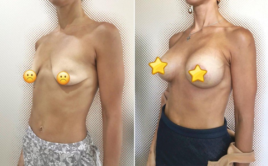 Увеличение груди имплантами