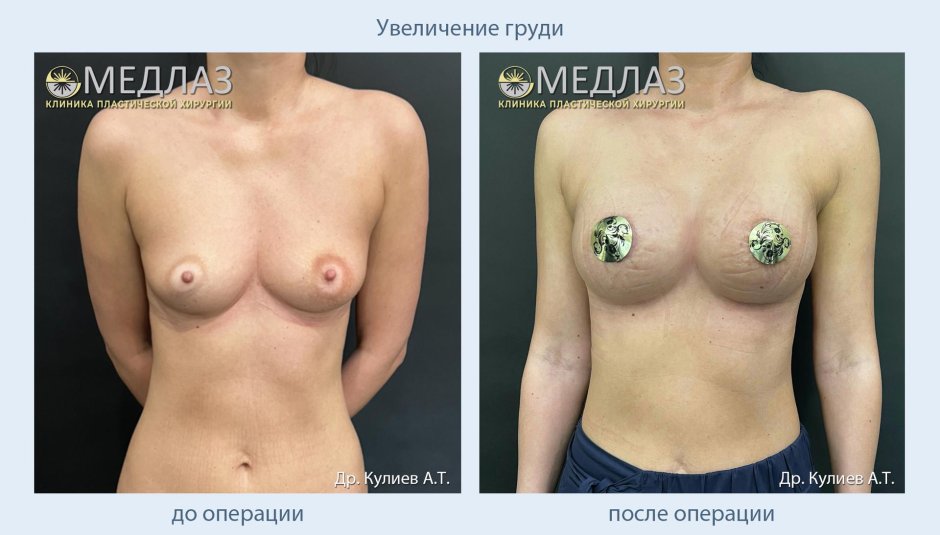 Увеличение груди москва