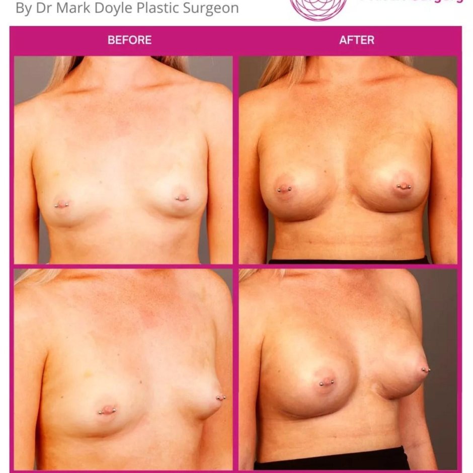 Грудь пластика