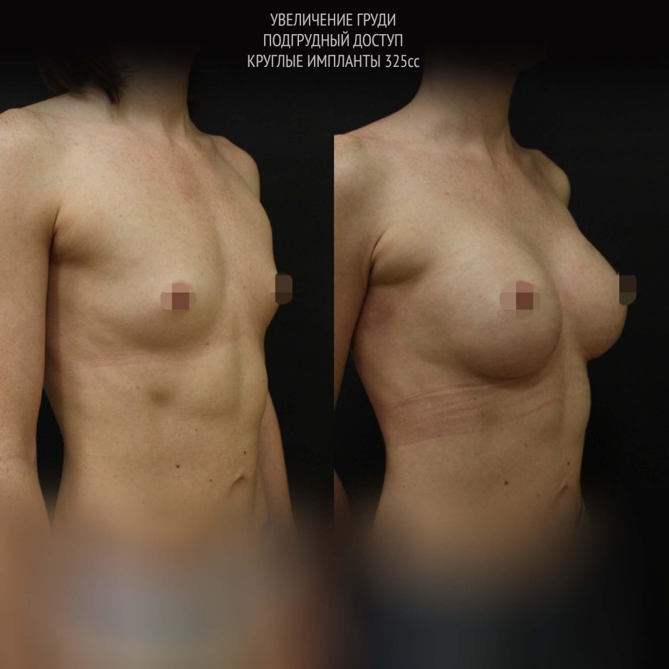 Красивая грудь с имплантами
