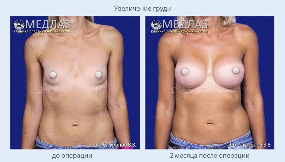 Увеличение груди москва