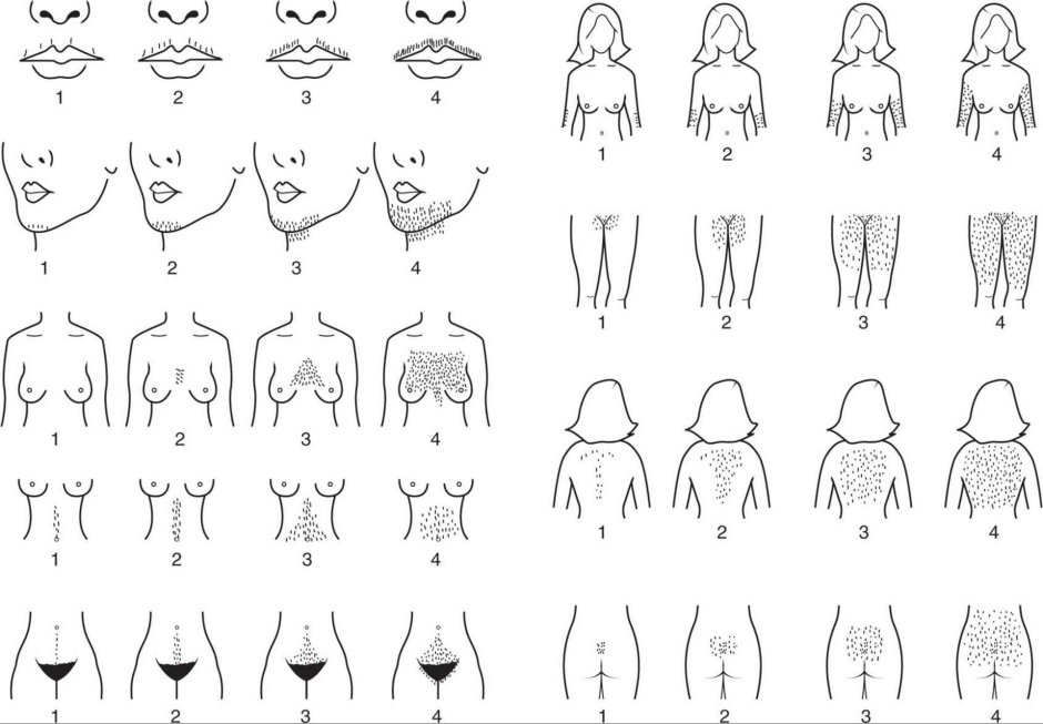 Шкала ферримана голлвея гирсутизм