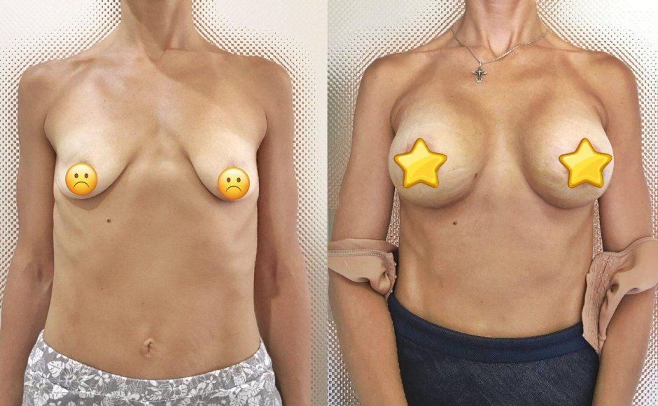 Увеличенная грудь