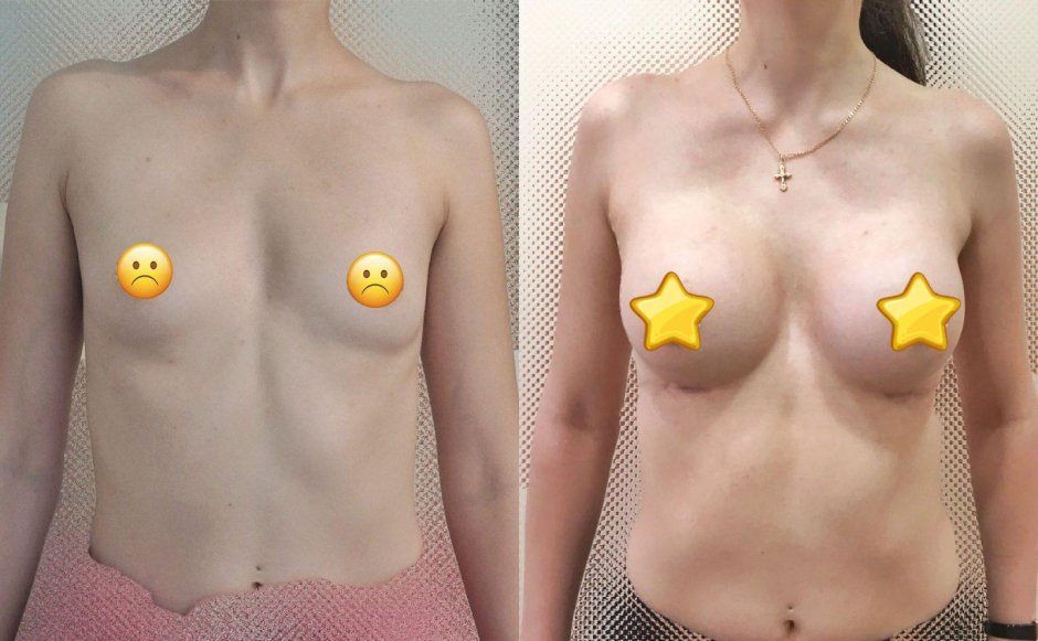 Маммопластика до и после