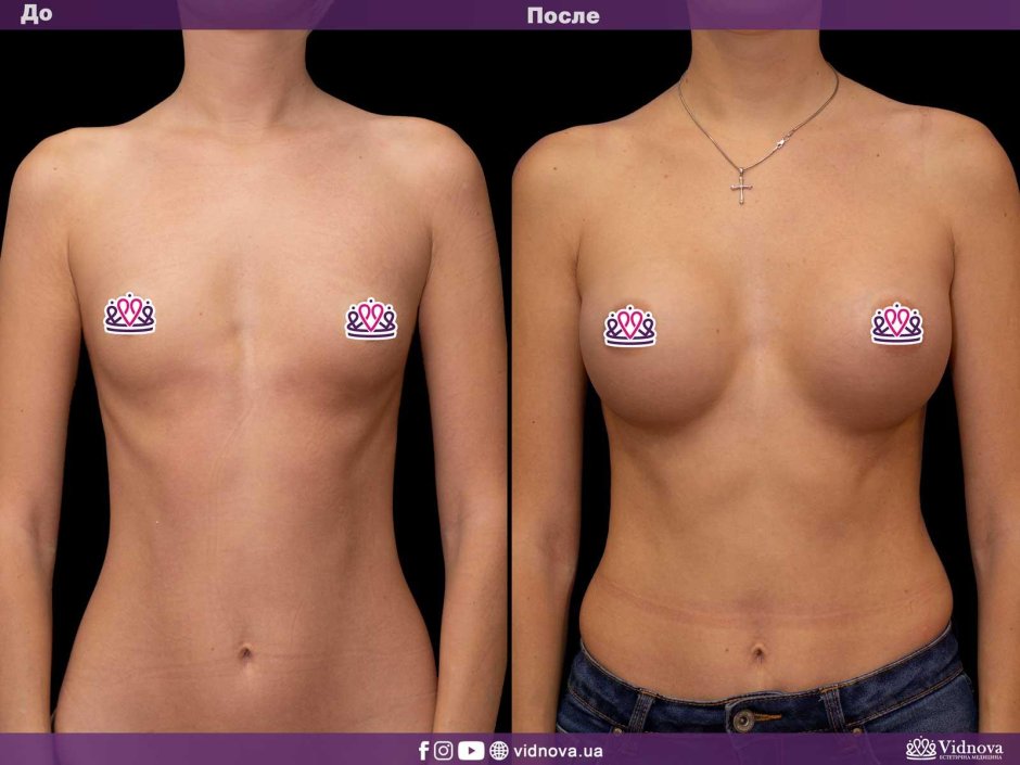 Грудь пластика