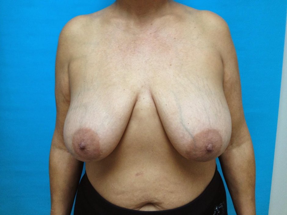 Уменьшение грудных желез