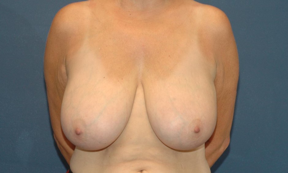 Уменьшение грудных желез