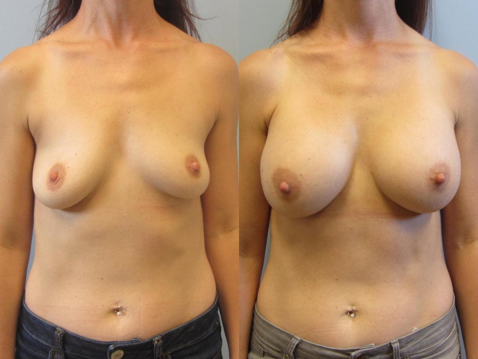 Идеальная грудь