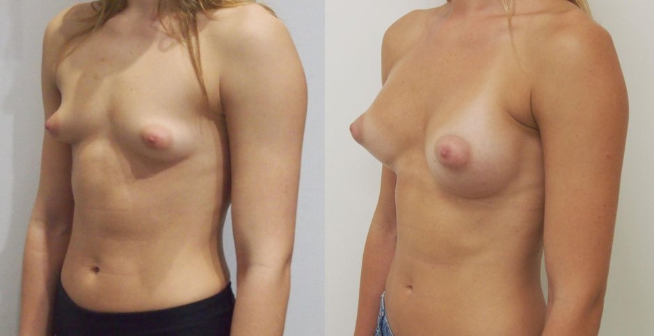 Увеличение груди гормонами у транссексуалов