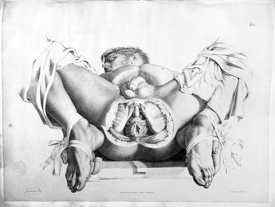 Плодоразрушающие плодоразрушающие операции