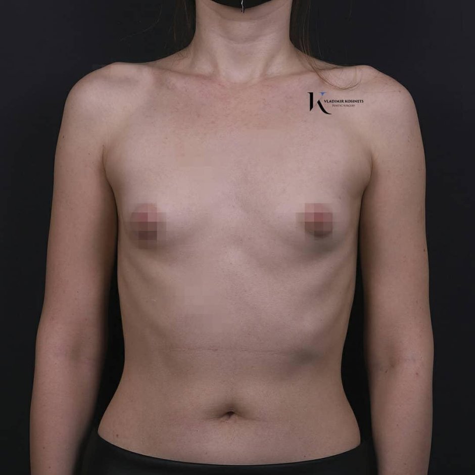 Тубулярная грудь