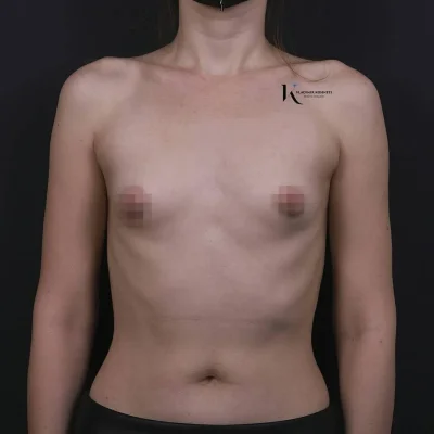 Тубулярная грудь