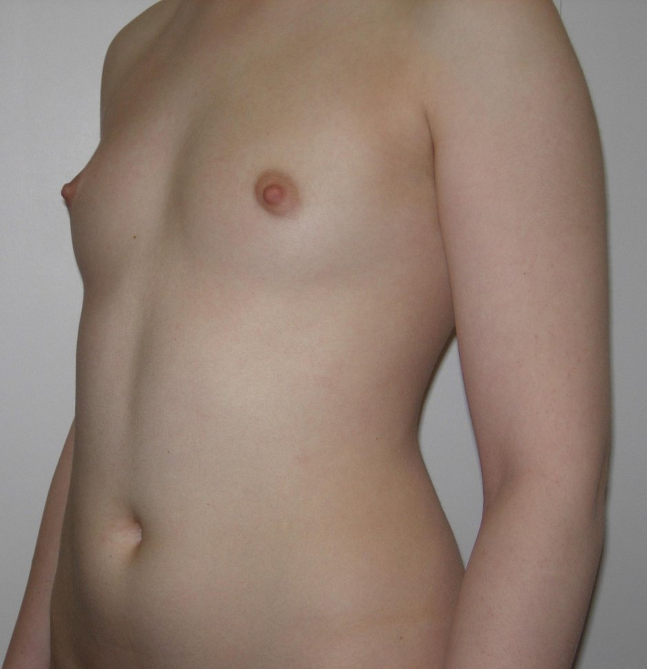 Грудь пластика