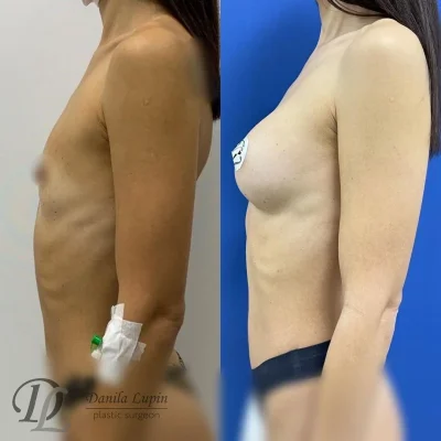 Увеличение грудных желез