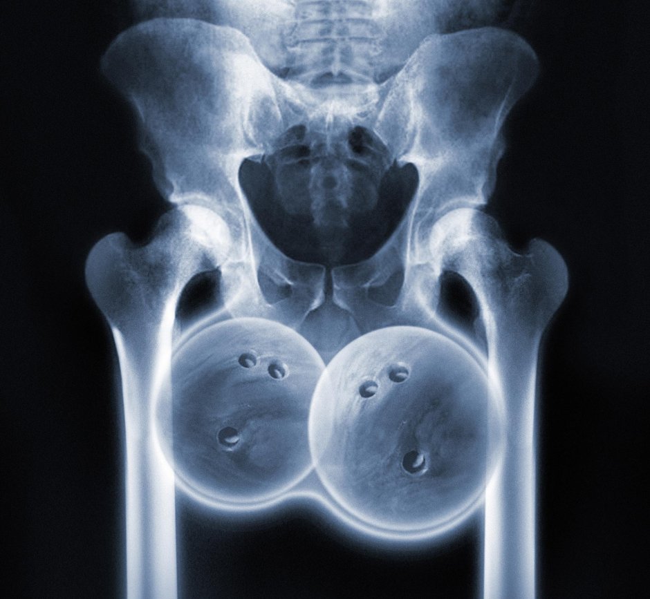 Рентген тазобедренного сустава