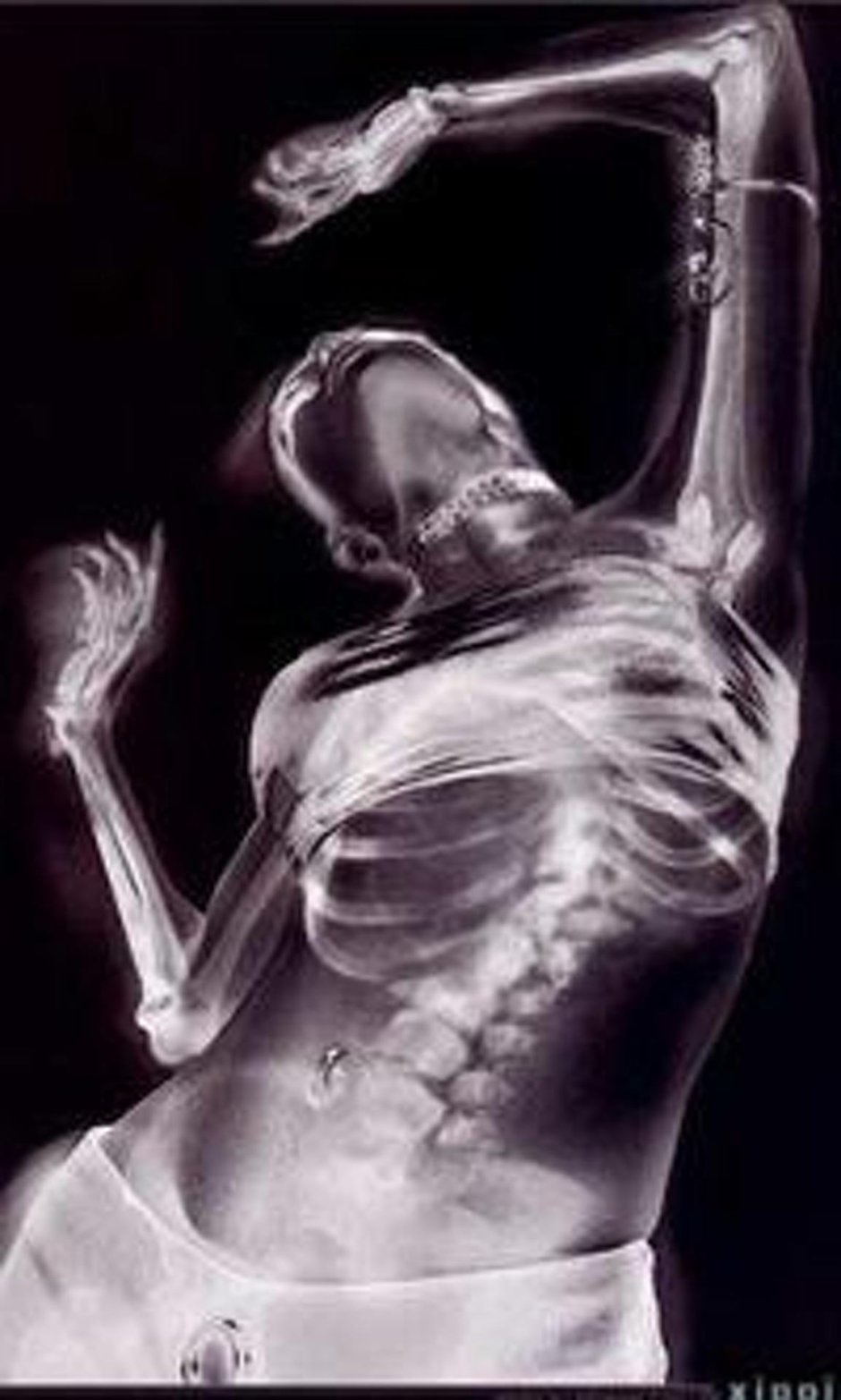 Рентген скелета человека