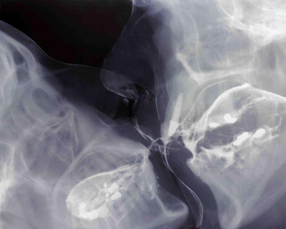 Рентген глубокого горла