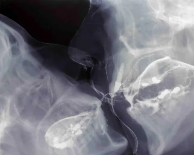 Рентген глубокого горла