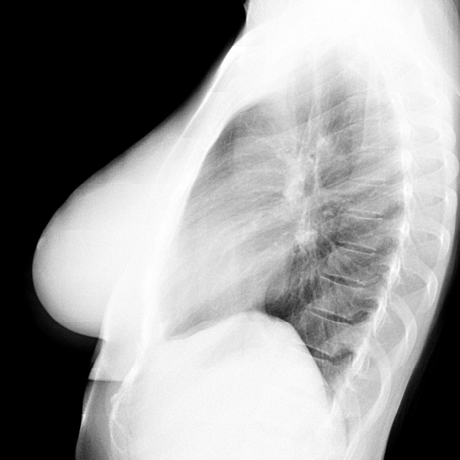 Пневмония рентген боковая проекция