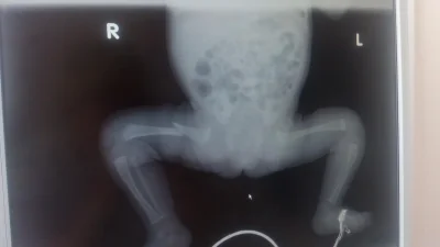 Болезнь несовершенный остеогенез