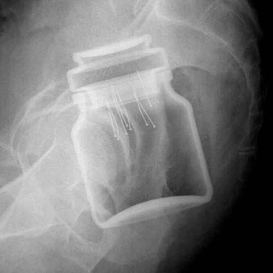 Необычные предметы на рентгене