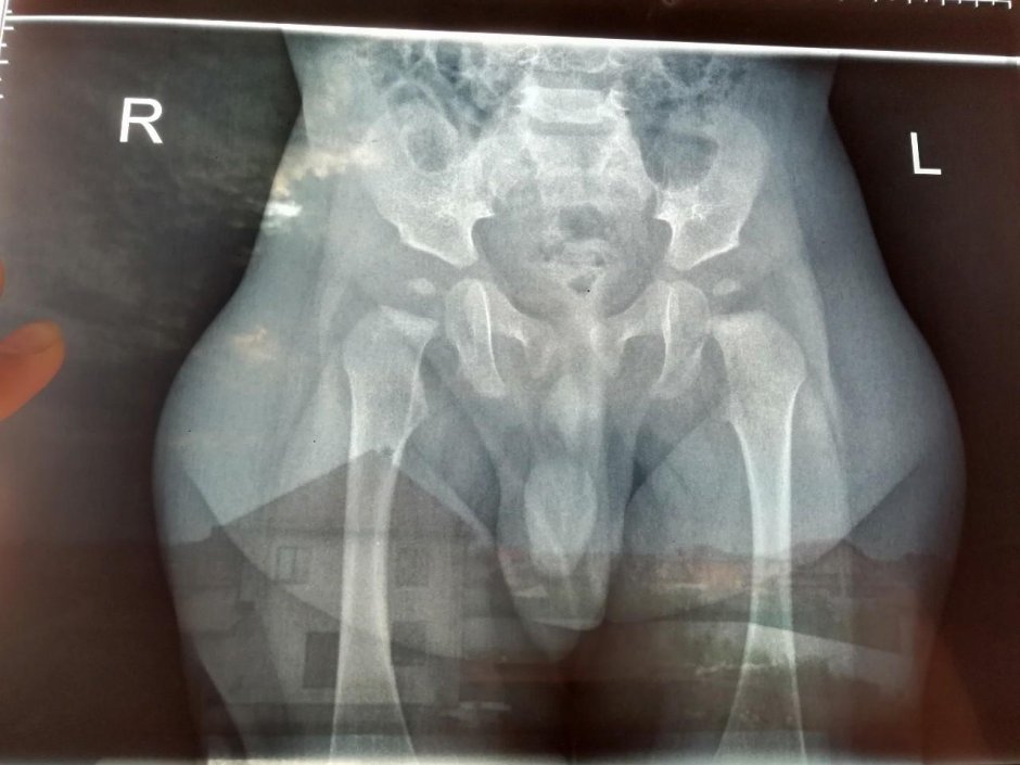 Рентген дисплазии тазобедренного сустава