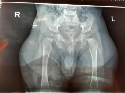Рентген дисплазии тазобедренного сустава