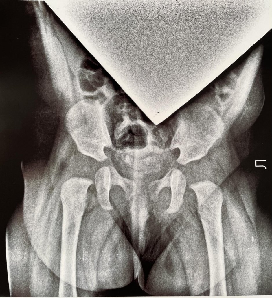 Рентген тазобедренного сустава у детей