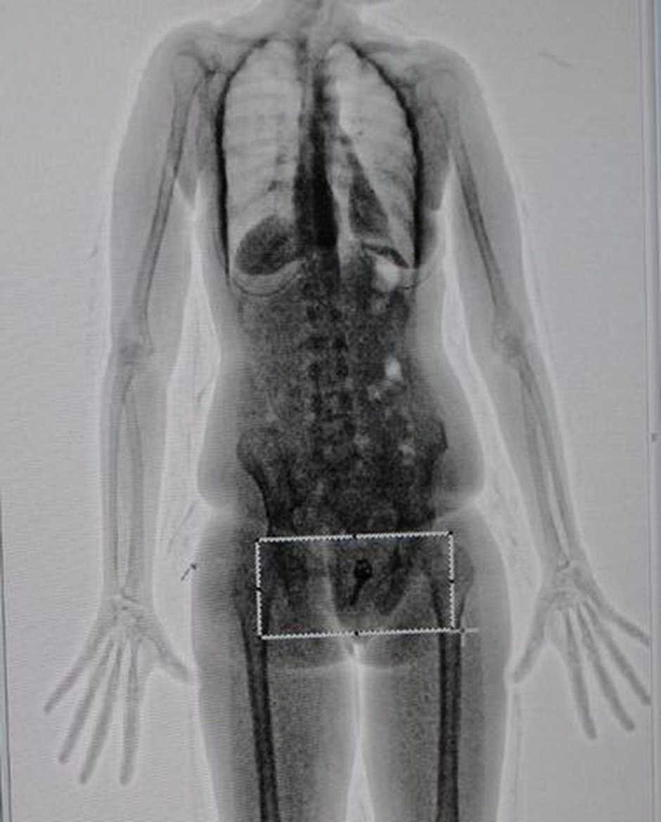 Рентген тела