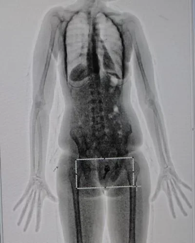 Рентген тела