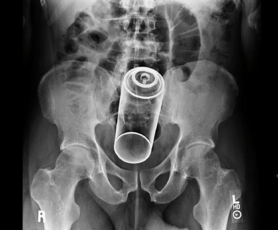 Инородные предметы на рентгене