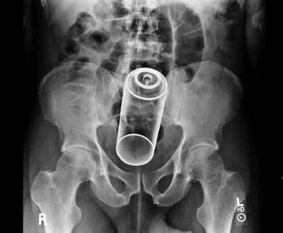 Инородные предметы на рентгене