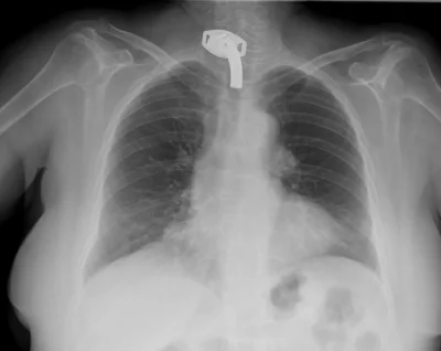 Легкие на рентгене