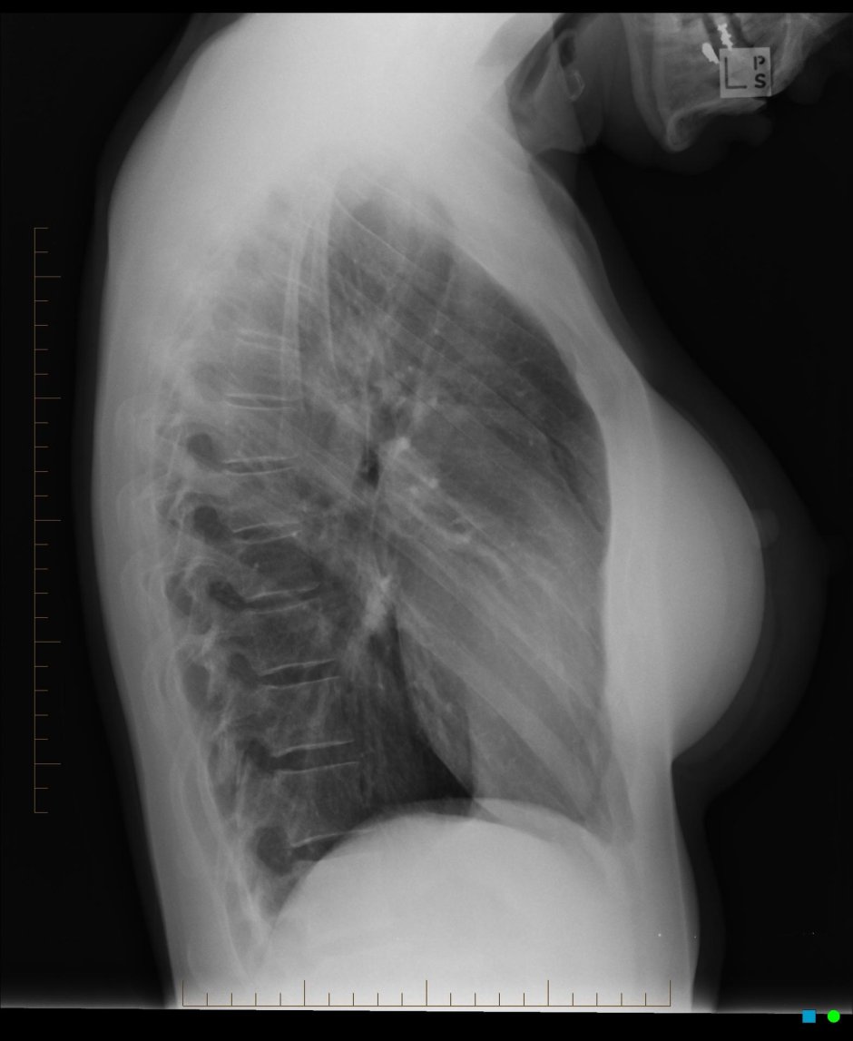 Пневмония рентген боковая проекция