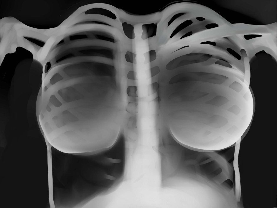 Грудная клетка рентген