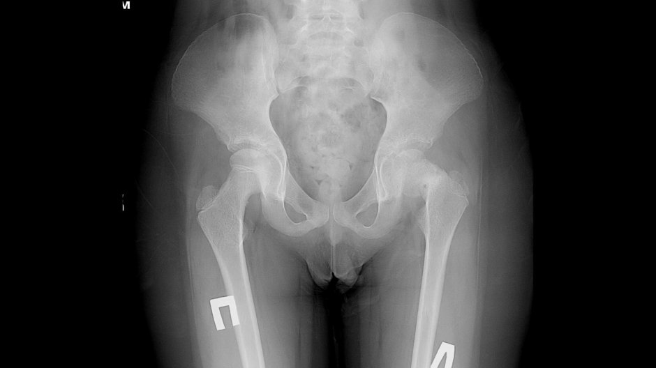 Рентген тазобедренных суставов