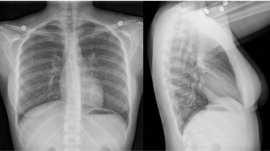 Рентген грудной клетки норма