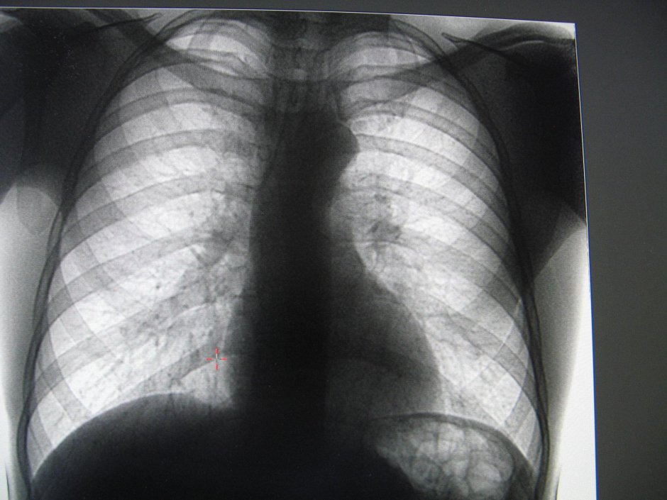 Загрудинный зоб рентген