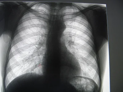 Загрудинный зоб рентген