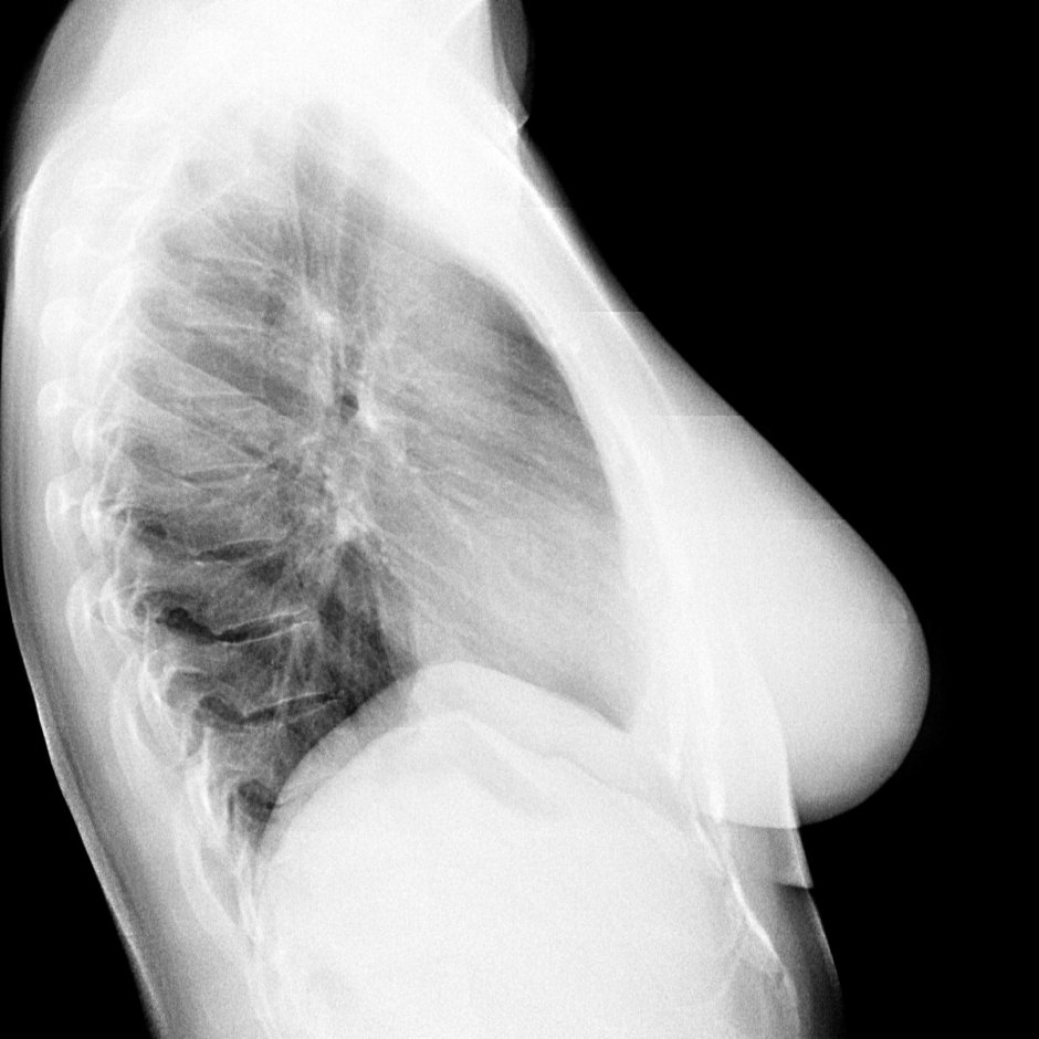 Снимок легких в боковой проекции