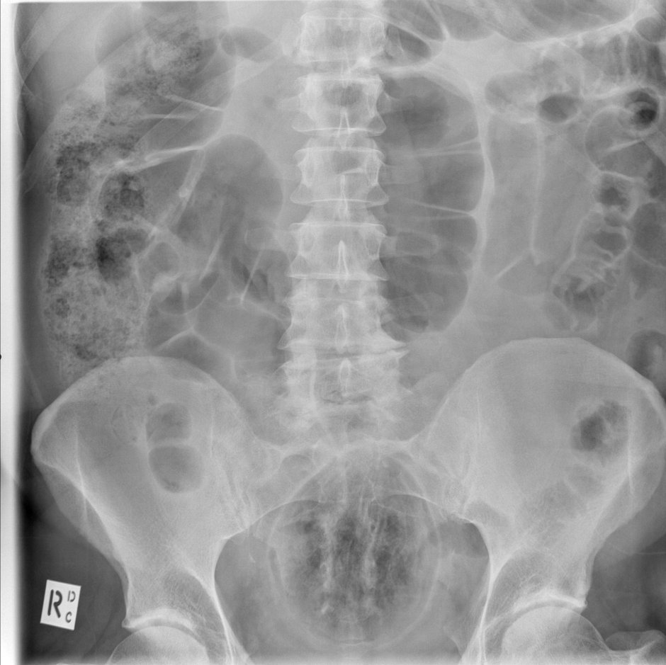 Экскреторная урография почек рентген