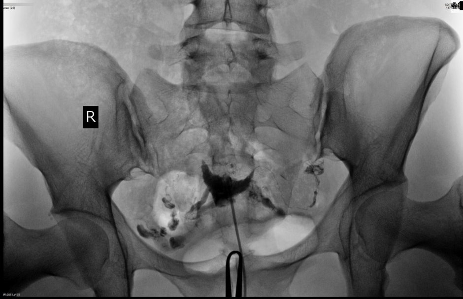 Гсг норма рентген