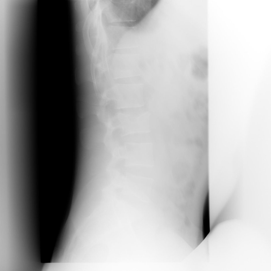 Невринома позвоночника рентген