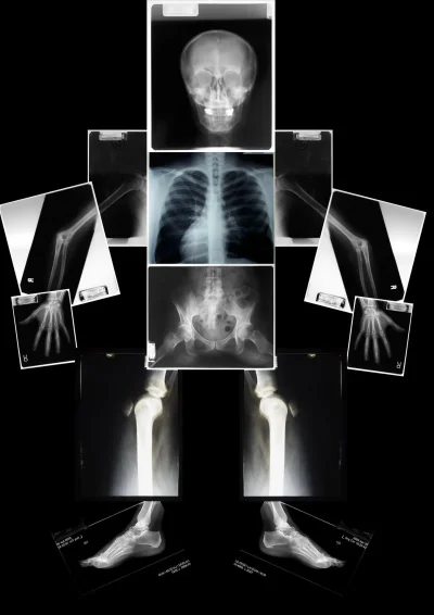 Рентген костей таза сакроилеит