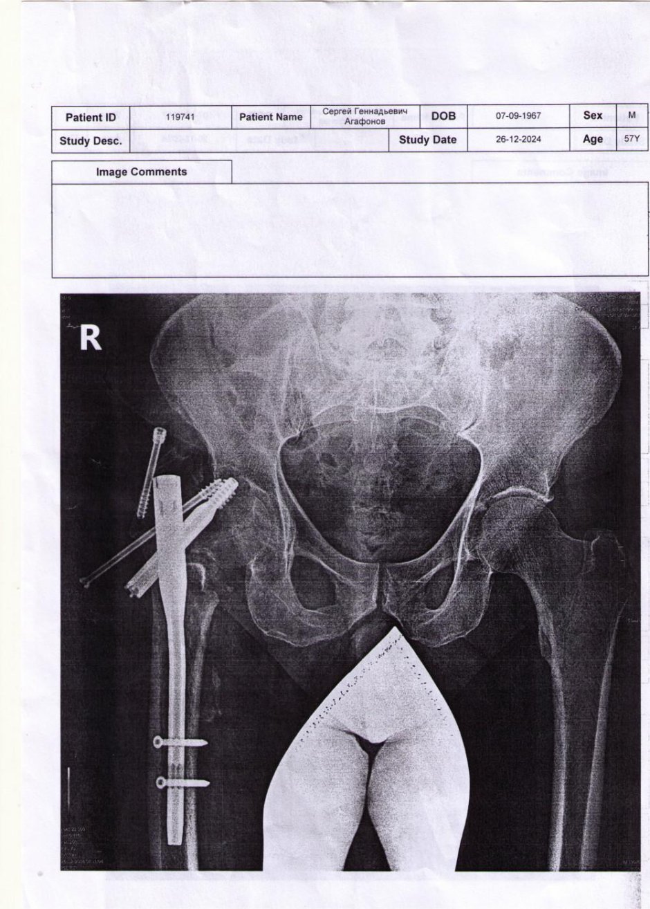 Чрезвертельный перелом остеосинтез