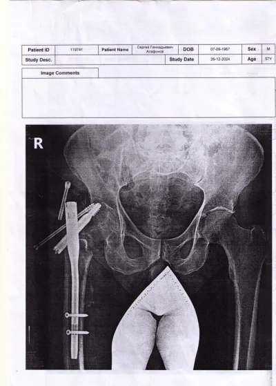 Чрезвертельный перелом остеосинтез