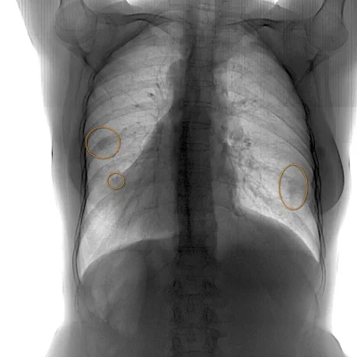 Рентген легких