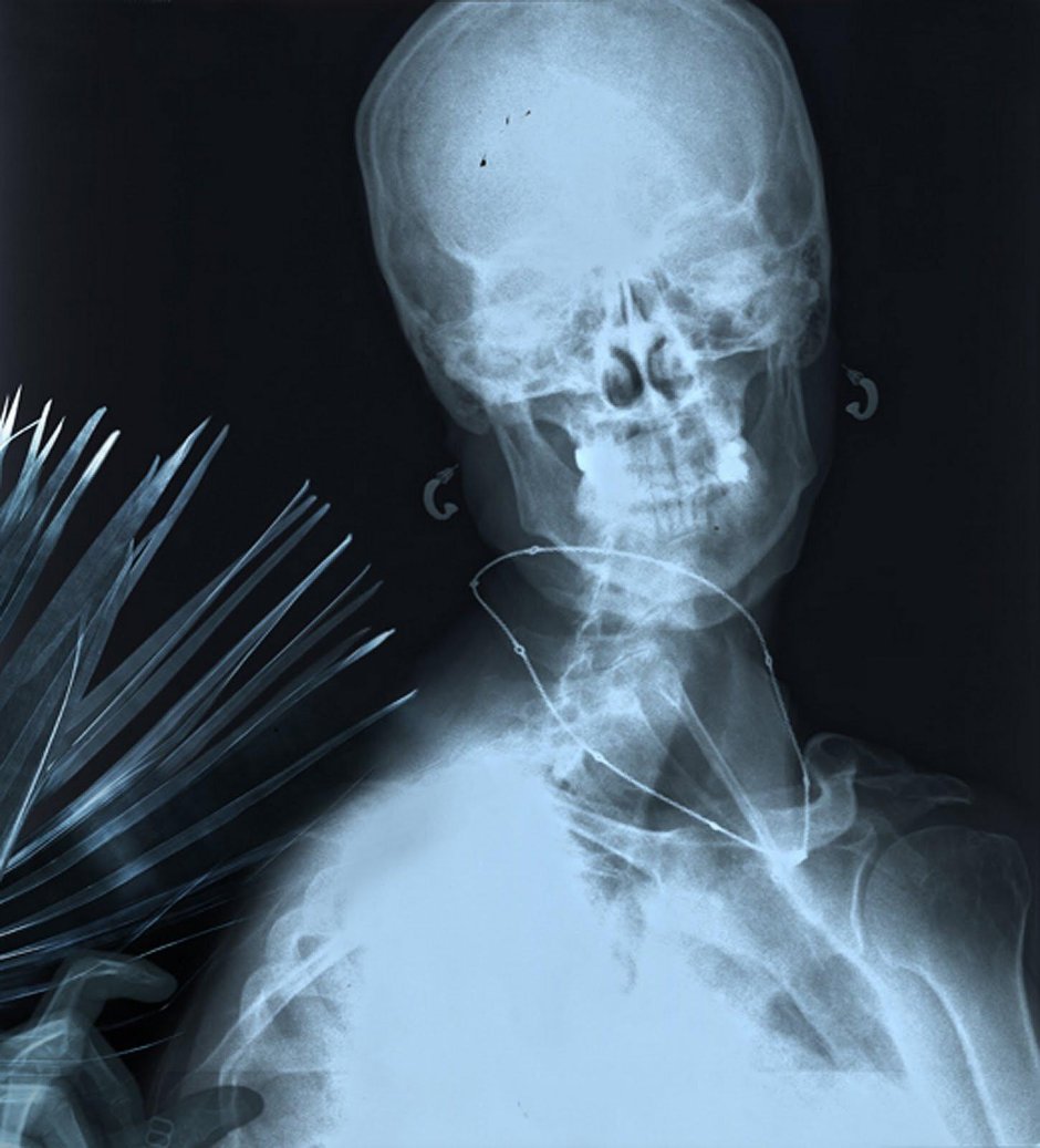 Рентген череп