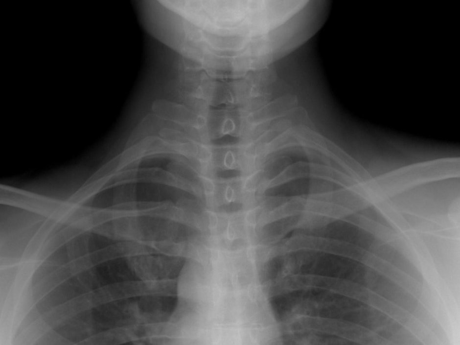 Перелом ключицы рентгенография